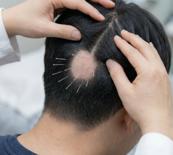 순환 및 자생 침치료 (면역 독소 배출)